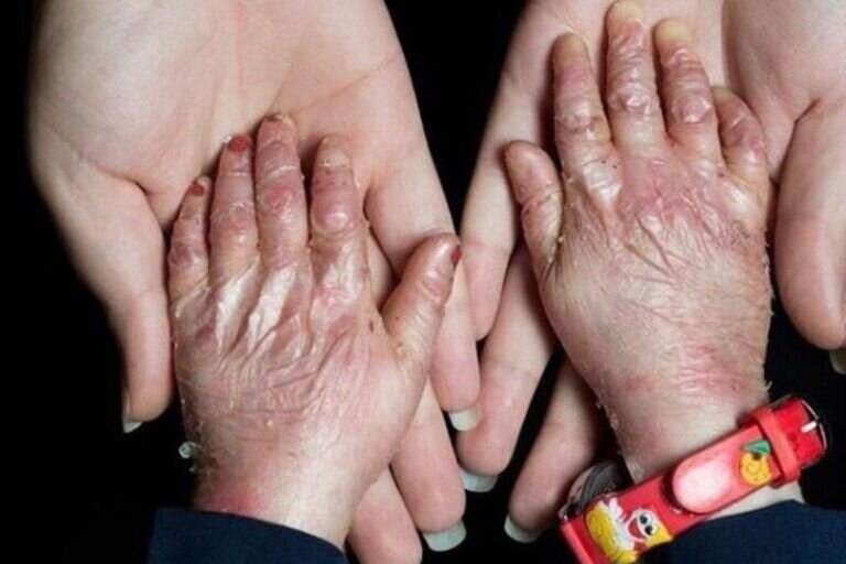 ۲۵ بیماری جدید به فهرست بیماری‌های نادر کشور اضافه شد